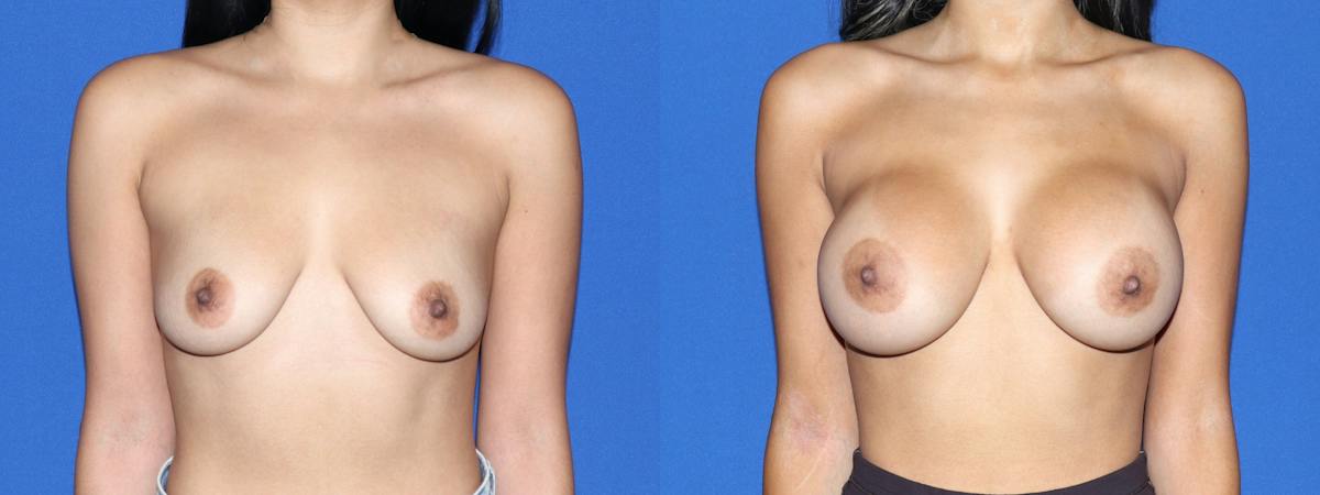 Breast Augmentation Before & After Gallery - Patient 531965 - Image 2