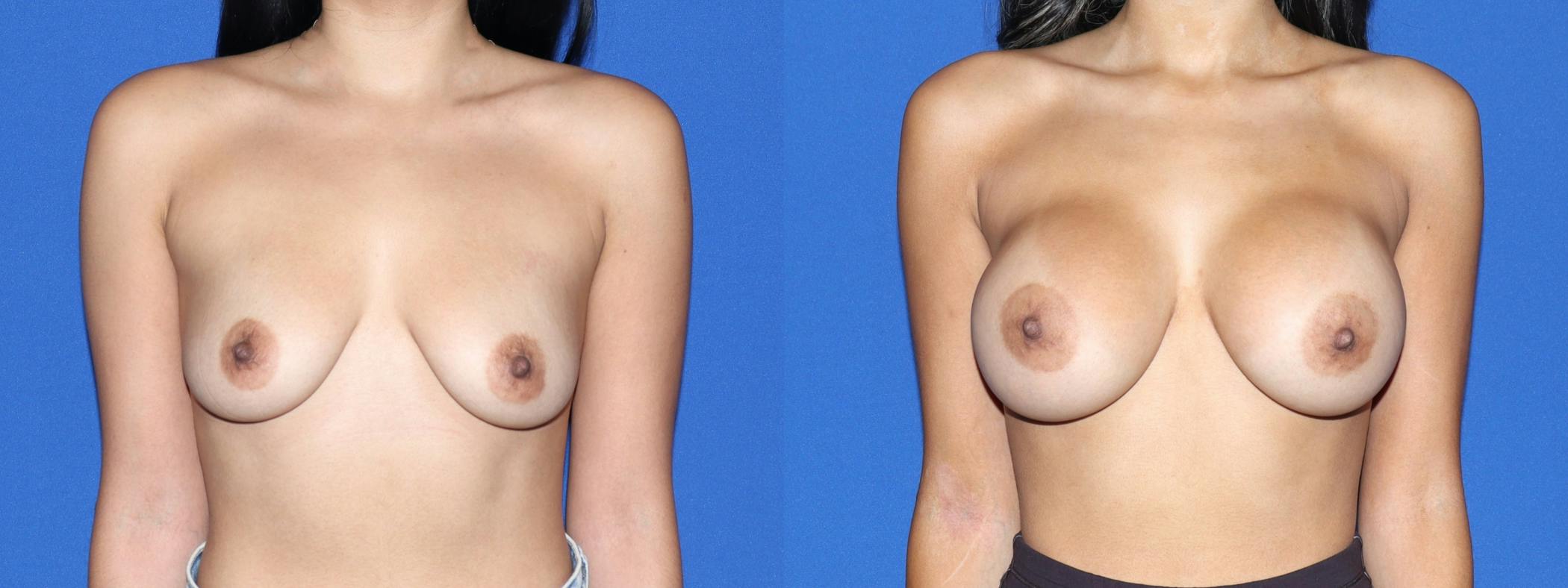 Breast Augmentation Before & After Gallery - Patient 531965 - Image 2