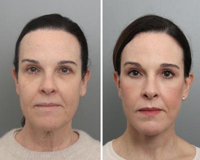 Facelift Before & After Gallery - Patient 113237 - Image 1