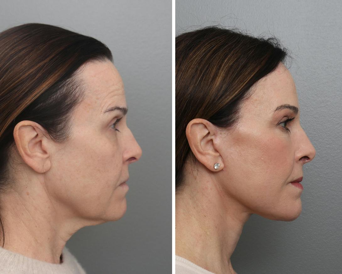 Facelift Before & After Gallery - Patient 113237 - Image 2