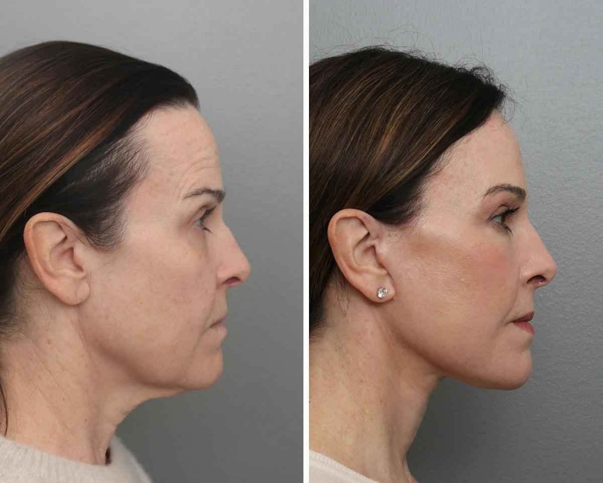 Facelift Before & After Gallery - Patient 113237 - Image 2