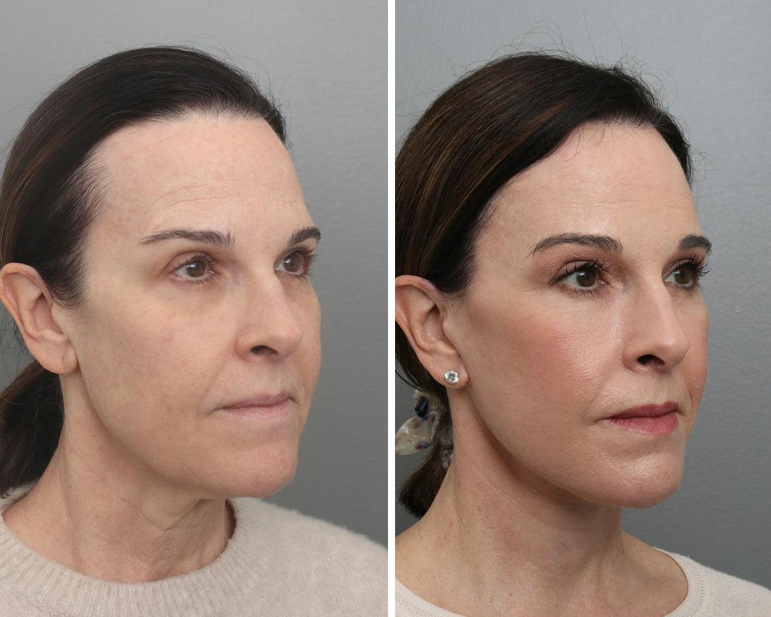 Facelift Before & After Gallery - Patient 113237 - Image 3