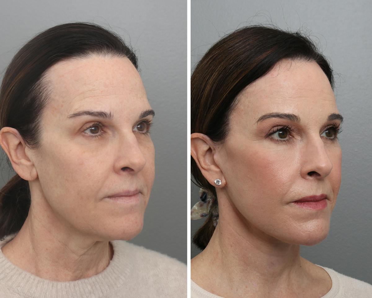 Facelift Before & After Gallery - Patient 113237 - Image 3