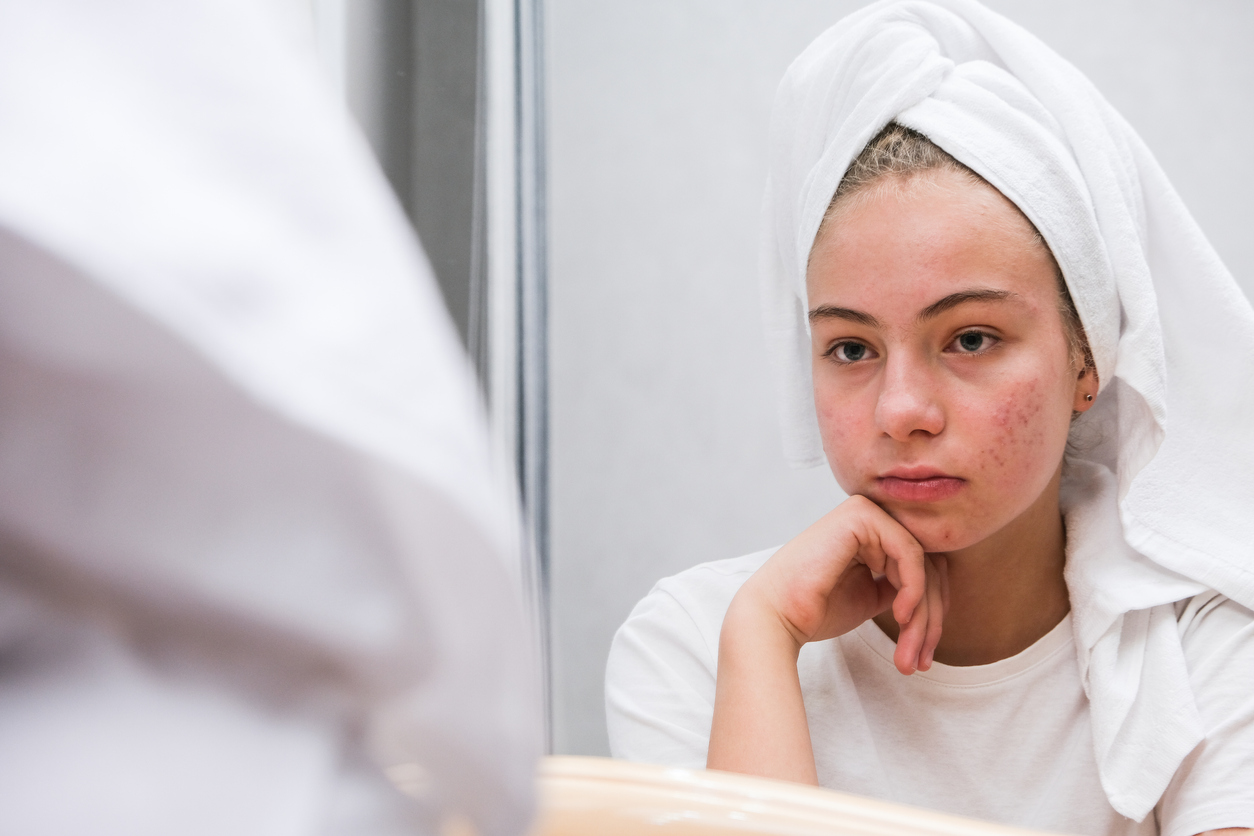 When Should I See A Dermatologist For Acne Blog Certified Dermatology