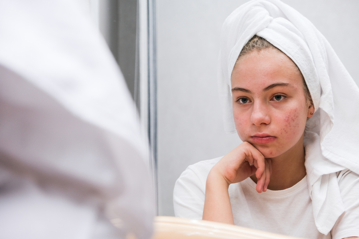 When Should I See A Dermatologist For Acne? Blog Certified Dermatology