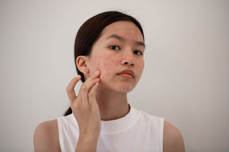 asian woman touching her facial acne