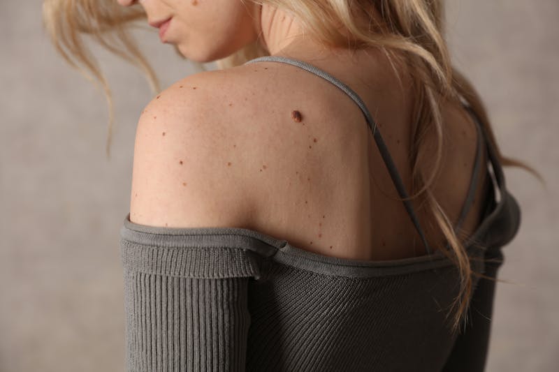 woman with birthmarks and moles on her shoulder