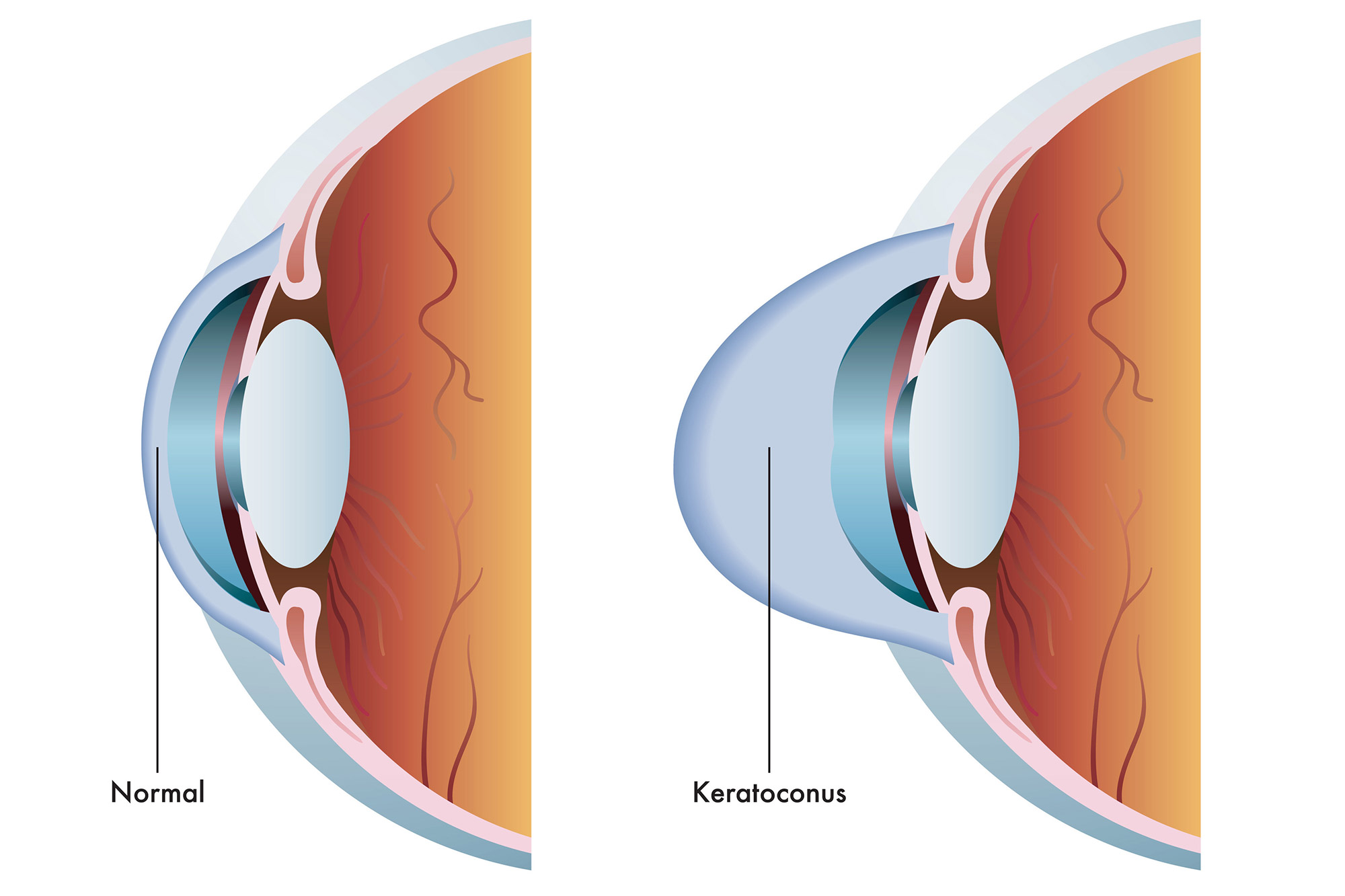 Image result for keratoconus