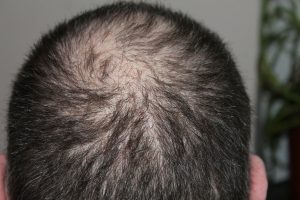 The Connections Between Hormones and Hair Loss - SRMC