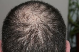 back of man's head with hair loss