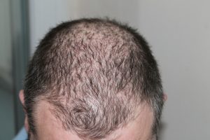 man with hair loss on top of head