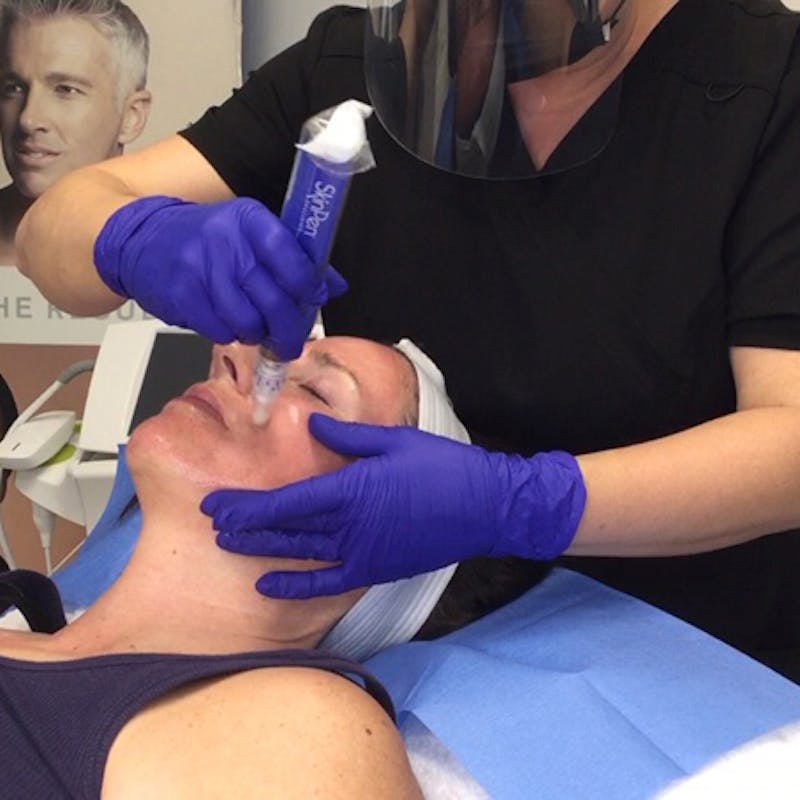 woman receiving skin treatment at Seattle Regen #3