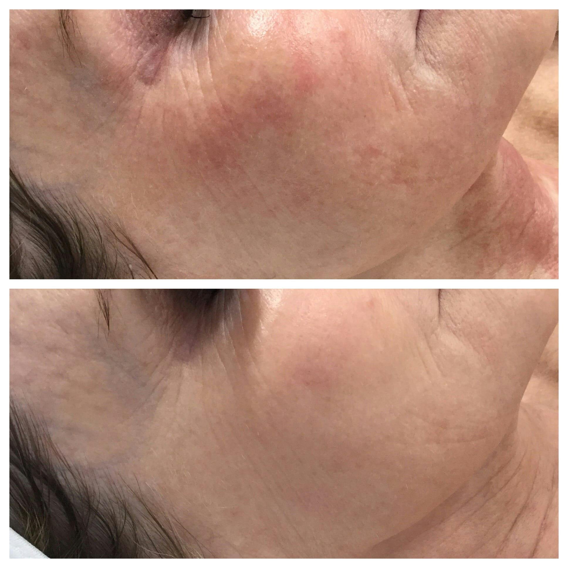 IPL Photofacial Before & After Gallery - Patient 76682036 - Image 1