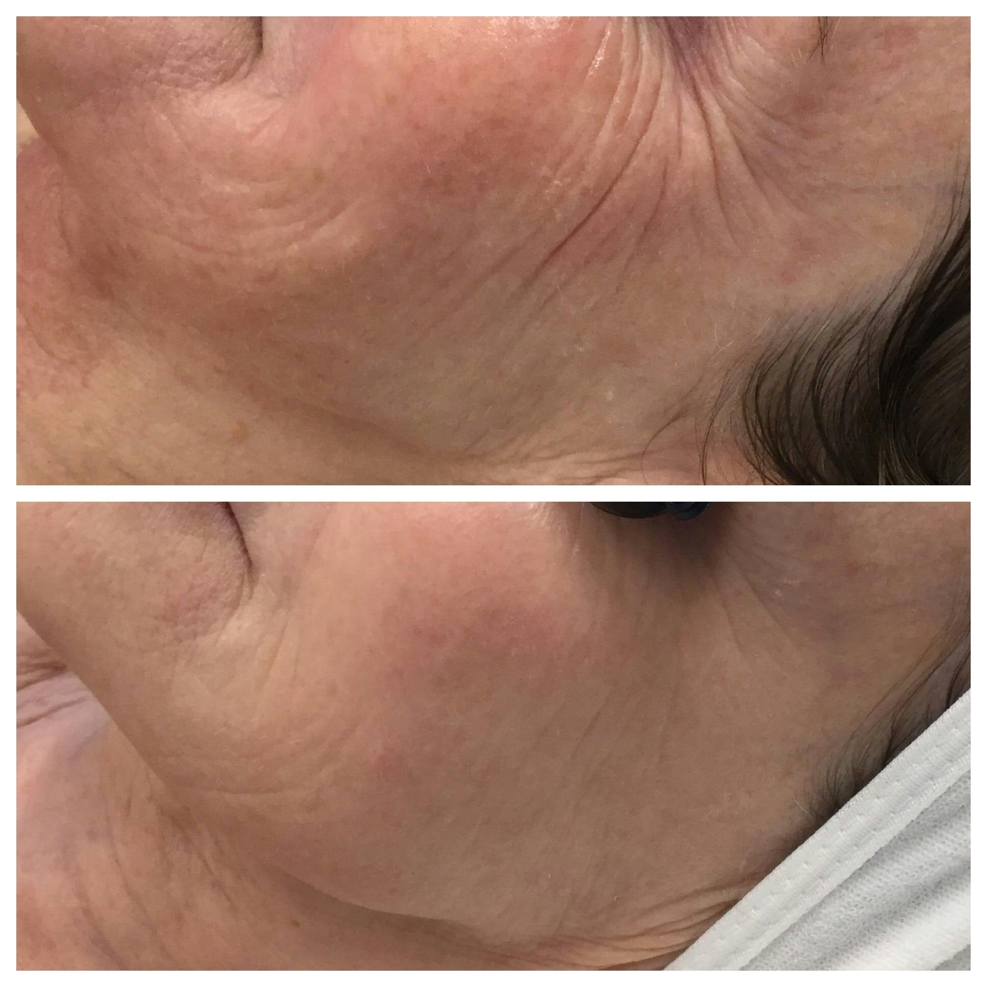 IPL Photofacial Before & After Gallery - Patient 76682036 - Image 2