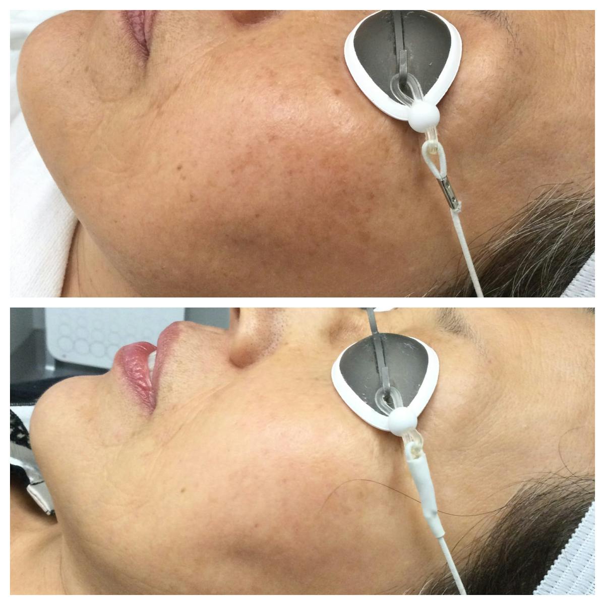 IPL Photofacial Before & After Gallery - Patient 76682037 - Image 1