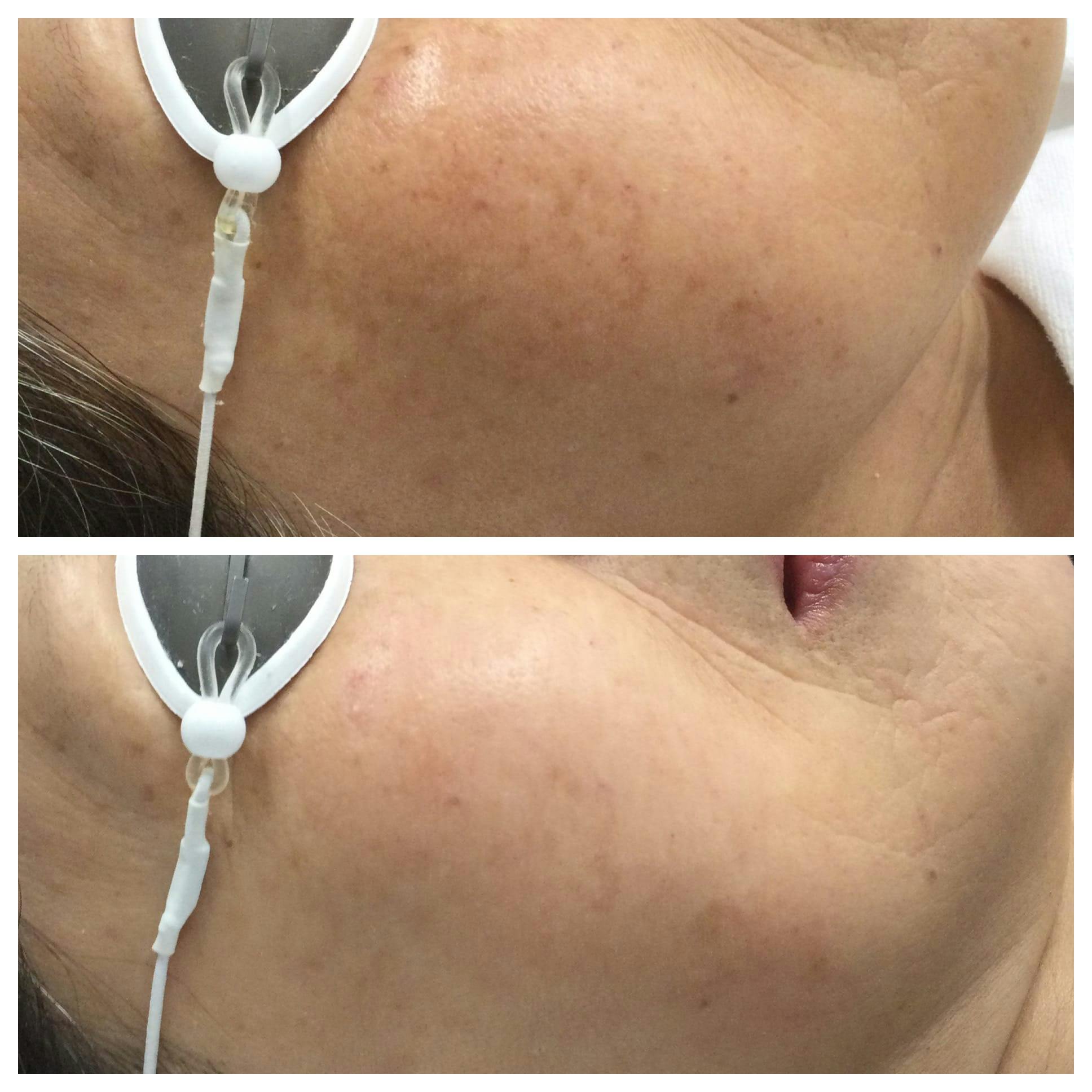 IPL Photofacial Before & After Gallery - Patient 76682037 - Image 2