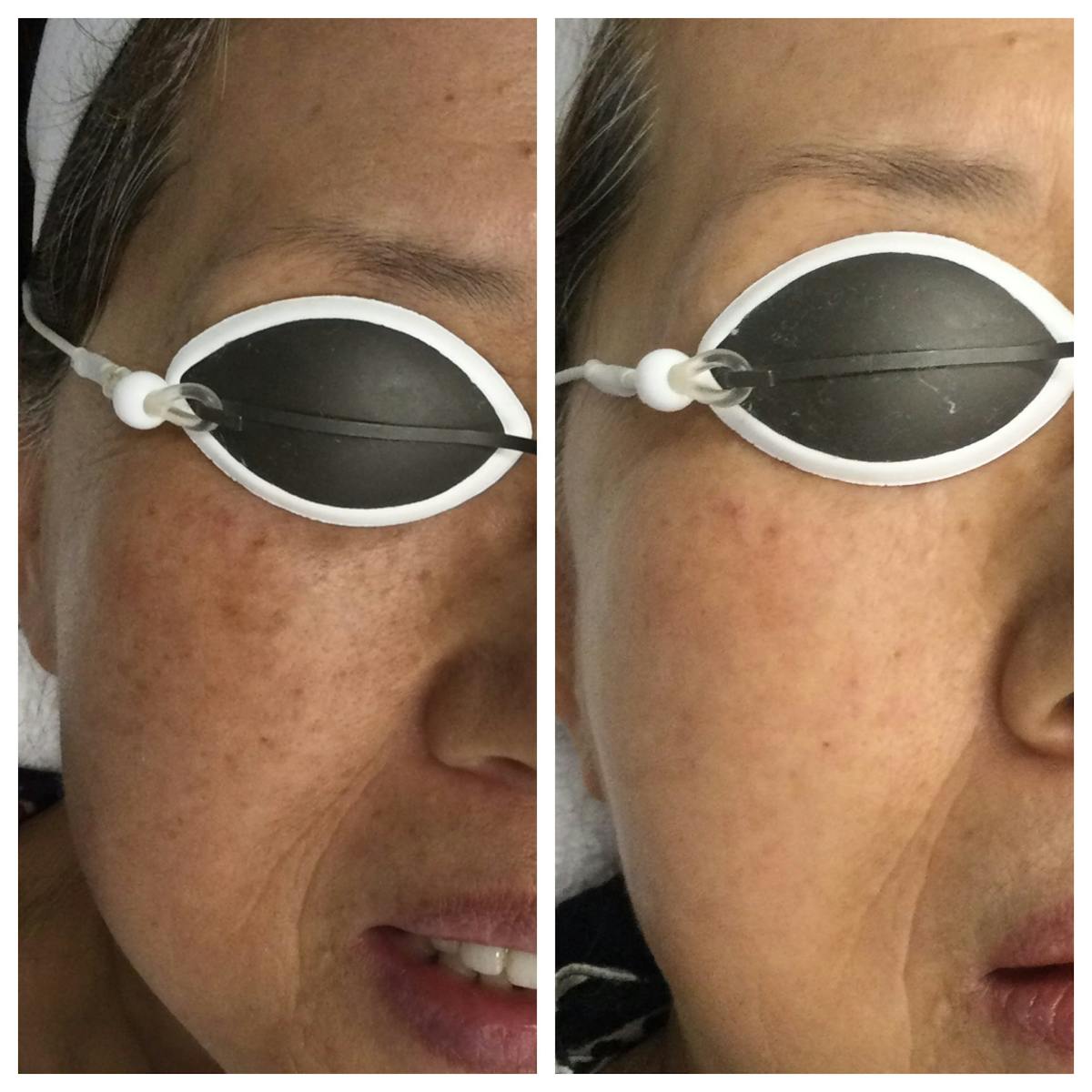 IPL Photofacial Before & After Gallery - Patient 76682037 - Image 3
