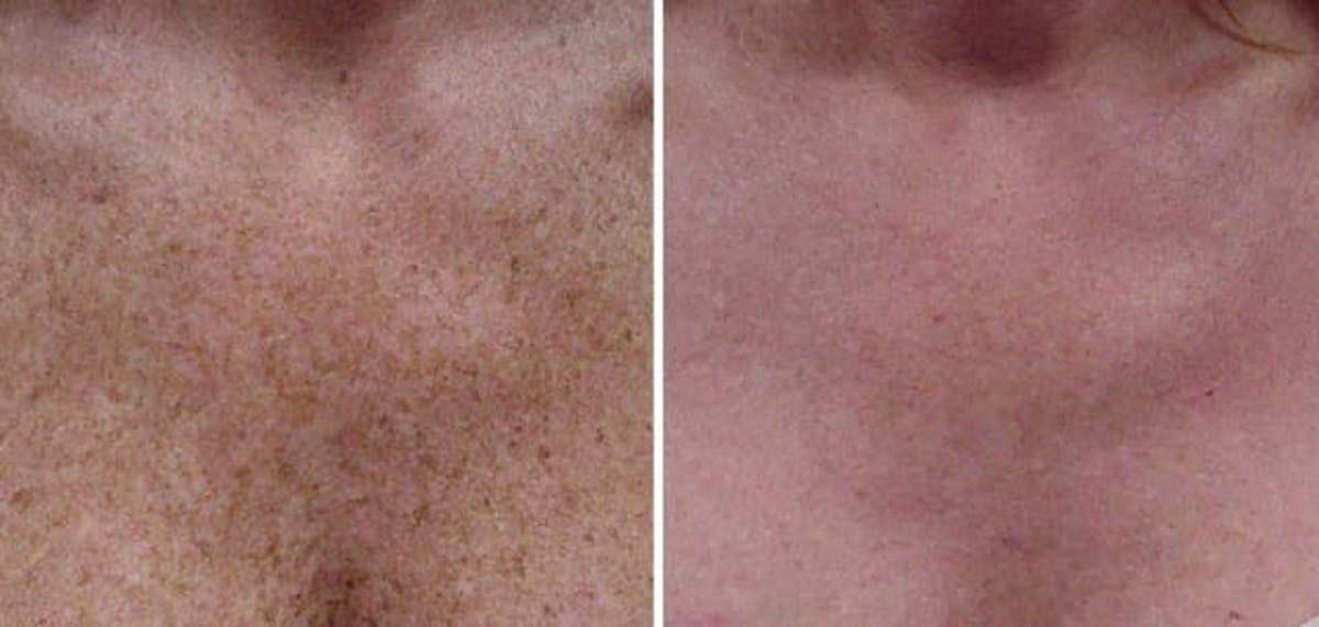 Skin Resurfacing Before & After Gallery - Patient 76682039 - Image 1