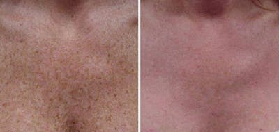 Skin Resurfacing Before & After Gallery - Patient 76682039 - Image 1