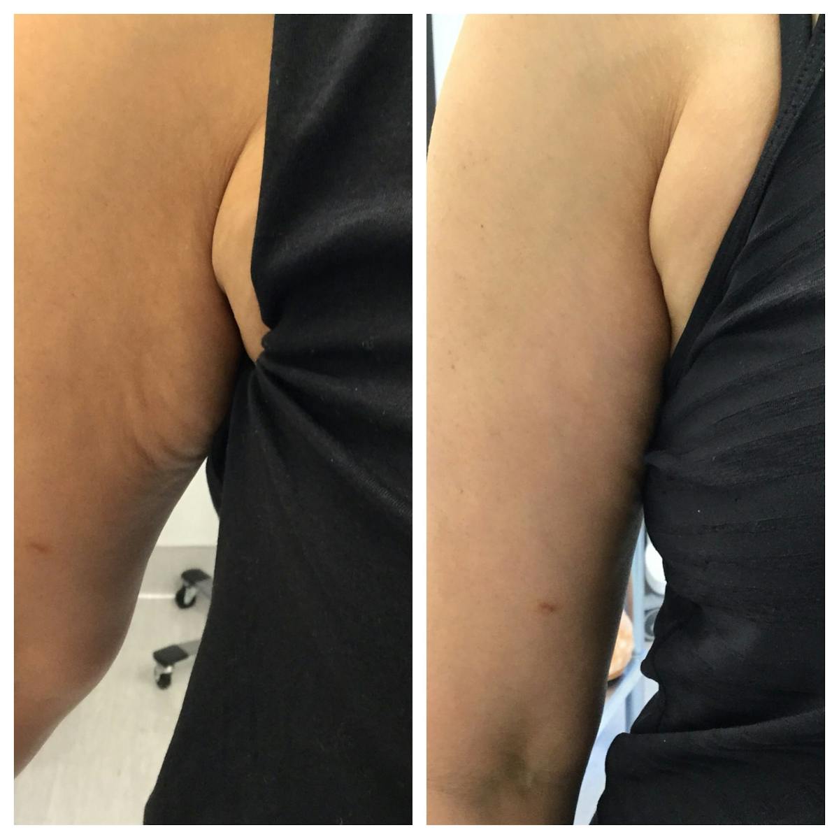 Body Contouring Before & After Gallery - Patient 76682043 - Image 1
