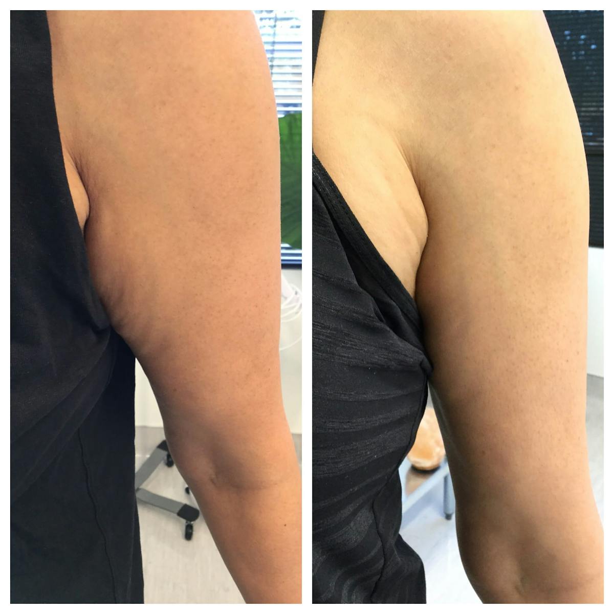 Body Contouring Before & After Gallery - Patient 76682043 - Image 2