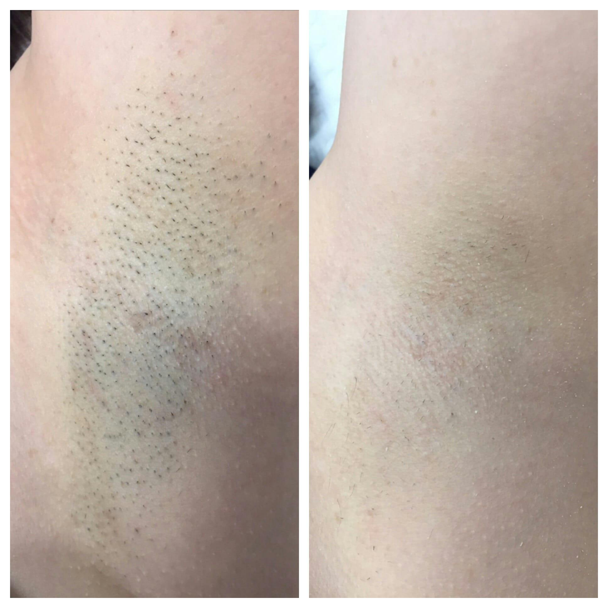 Laser Hair Removal Before & After Gallery - Patient 76682051 - Image 1