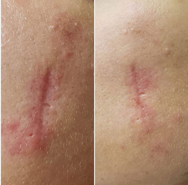Scar Treatments Before & After Gallery - Patient 76682054 - Image 1