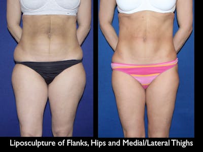 Liposuction Before & After Gallery - Patient 79204899 - Image 1