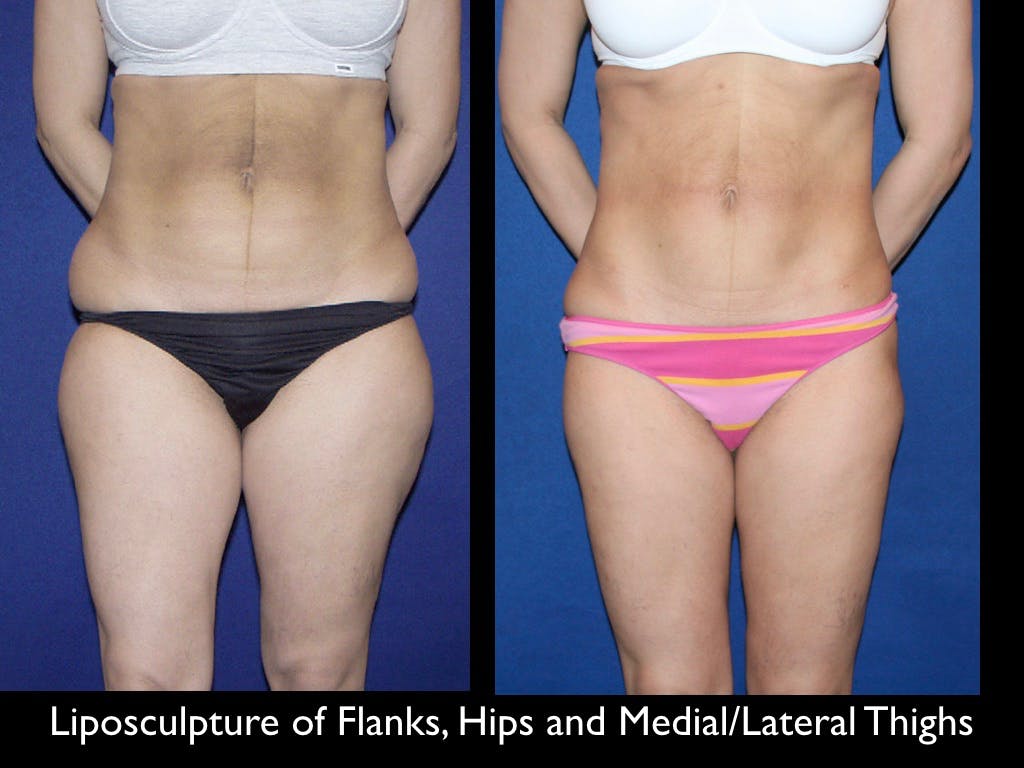 Liposculpsure Before & After Gallery - Patient 79204899 - Image 1