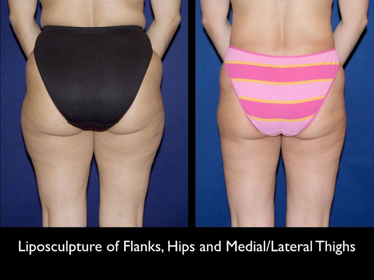 Liposuction Before & After Gallery - Patient 79204899 - Image 2