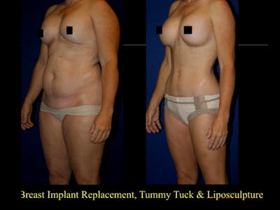 Tummy Tuck Before & After Gallery - Patient 79205143 - Image 1