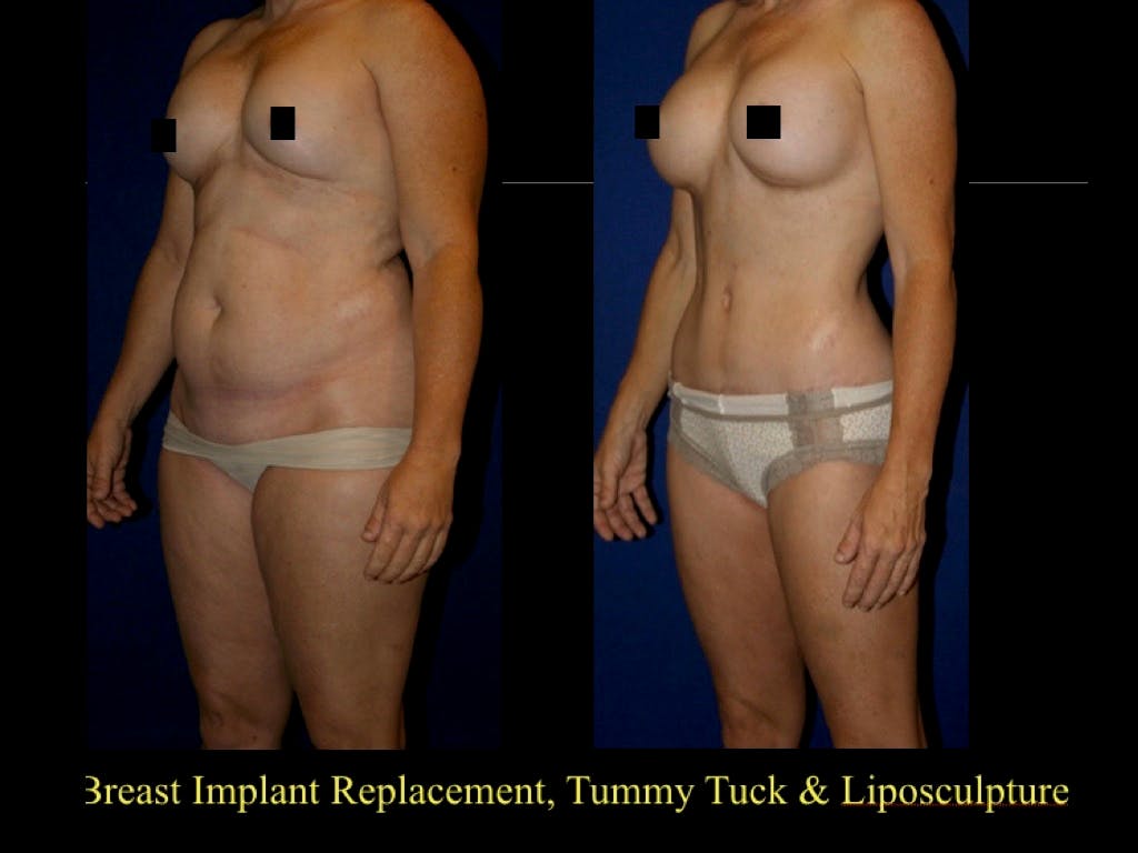 Tummy Tuck Before & After Gallery - Patient 79205143 - Image 1
