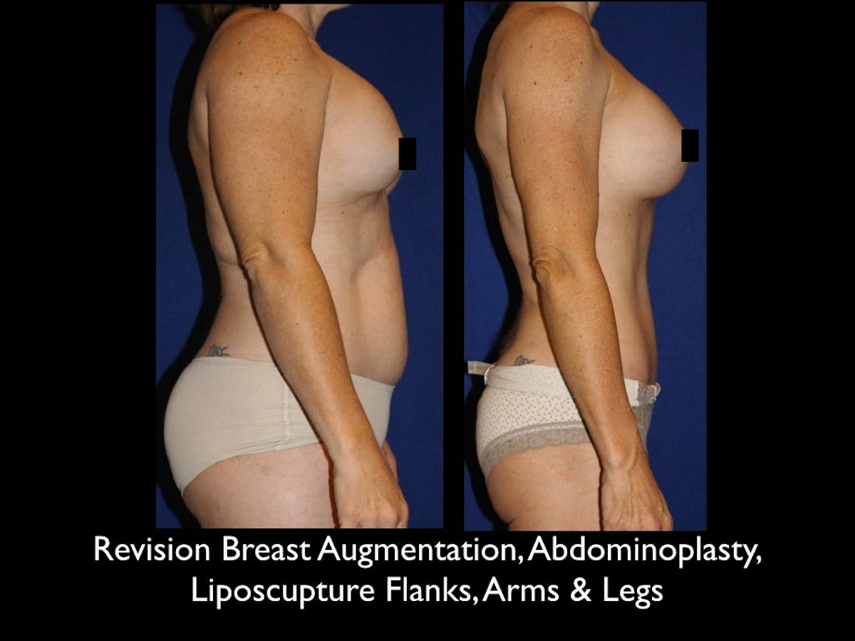 Liposuction Before & After Gallery - Patient 79204902 - Image 2