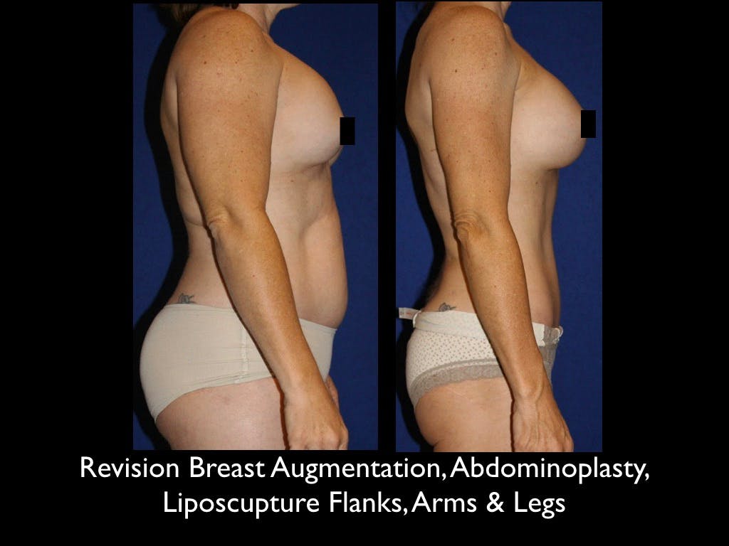 Liposculpsure Before & After Gallery - Patient 79204902 - Image 2