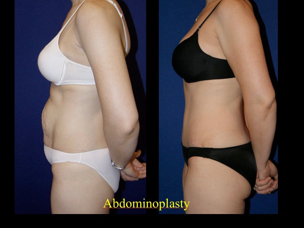 Tummy Tuck Before & After Gallery - Patient 79205144 - Image 1