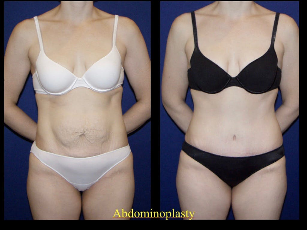 Tummy Tuck Before & After Gallery - Patient 79205144 - Image 2