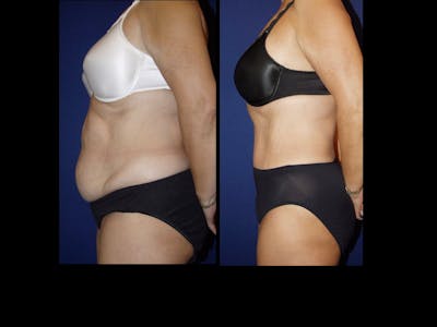 Tummy Tuck Before & After Gallery - Patient 79205145 - Image 1