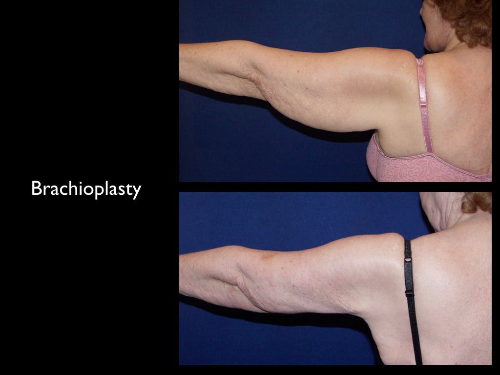 Arm Lift Before & After Gallery - Patient 68373540 - Image 1