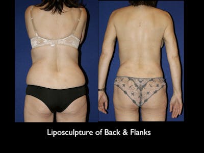 Liposculpsure Before & After Gallery - Patient 79204909 - Image 1