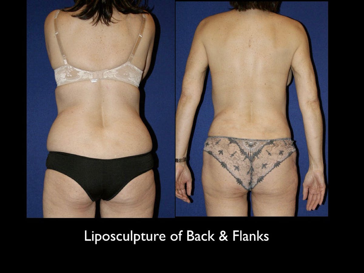 Liposculpsure Before & After Gallery - Patient 79204909 - Image 1