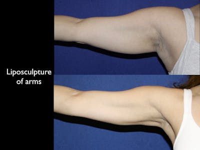 Arm Lift Before & After Gallery - Patient 68373542 - Image 1