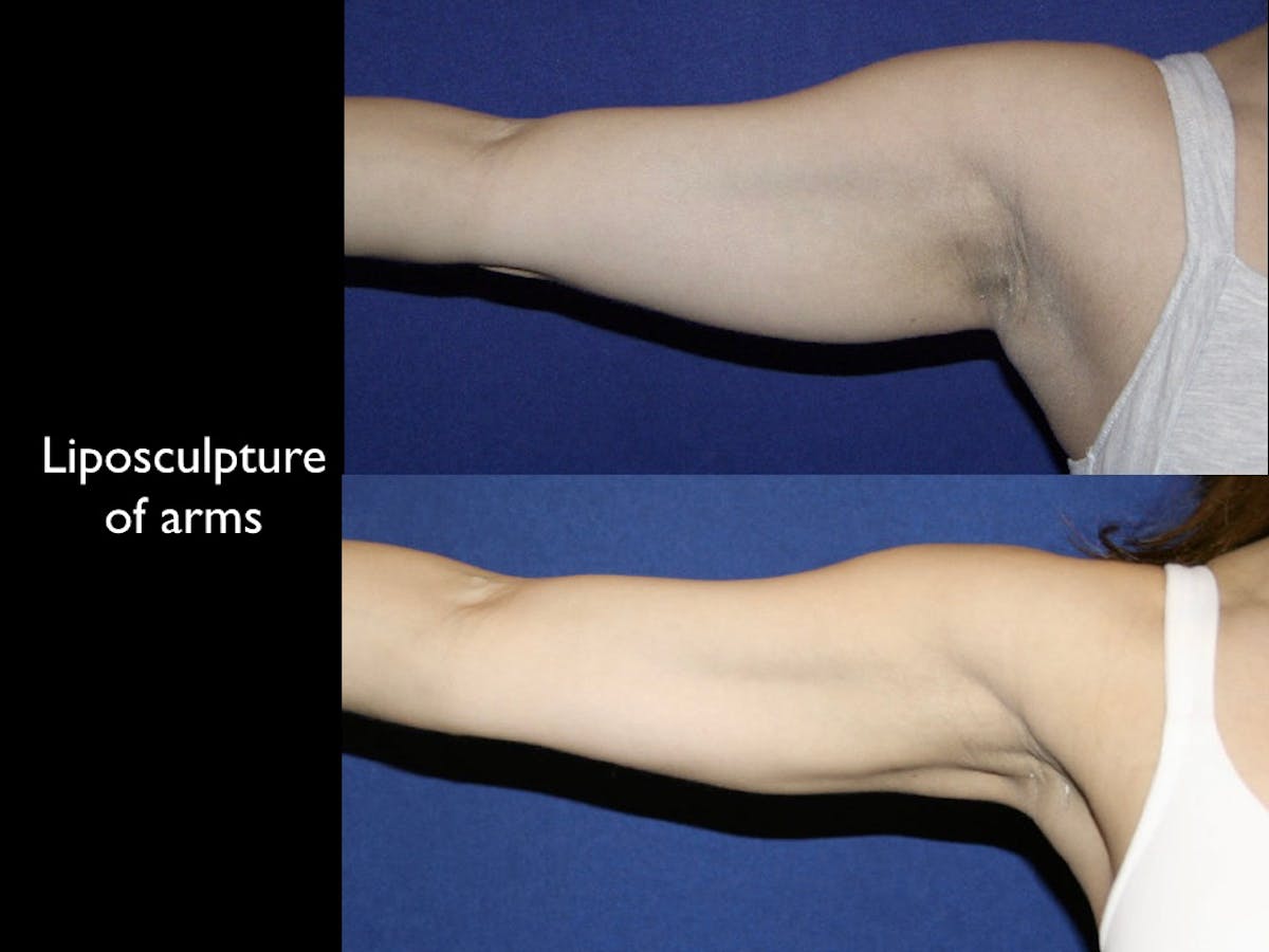 Arm Lift Before & After Gallery - Patient 68373542 - Image 1