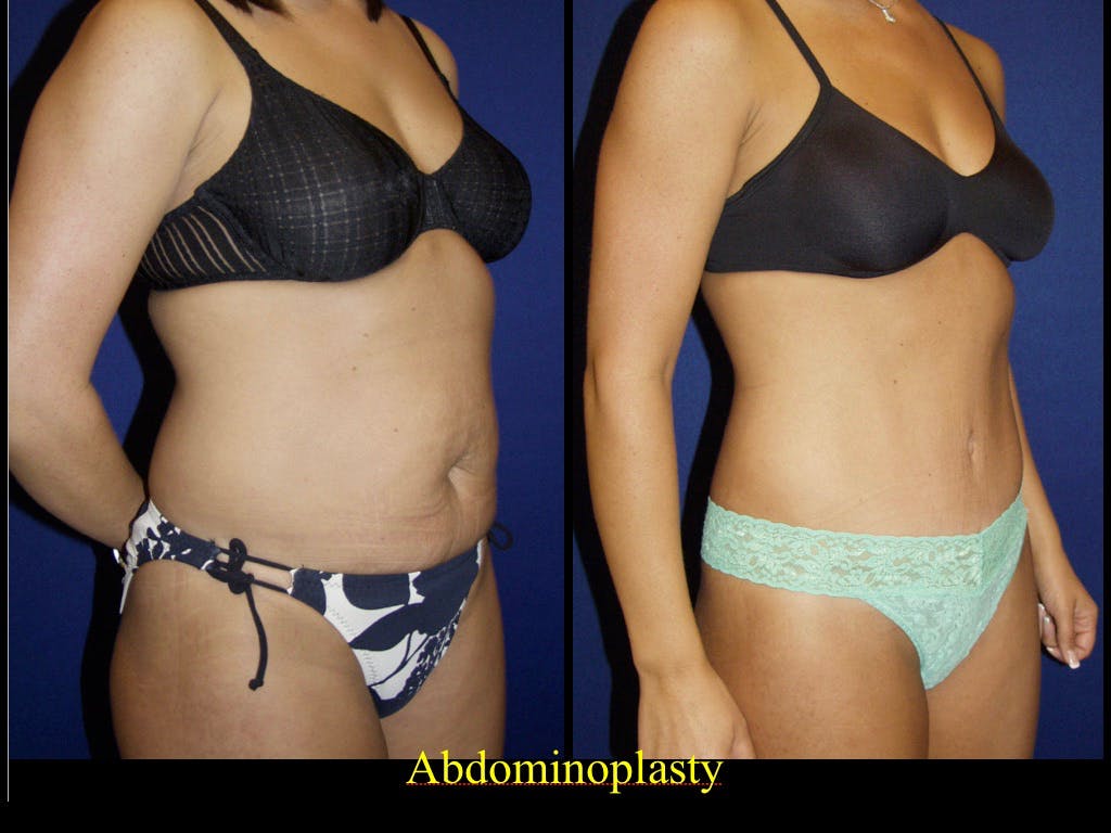 Tummy Tuck Before & After Gallery - Patient 79205149 - Image 1