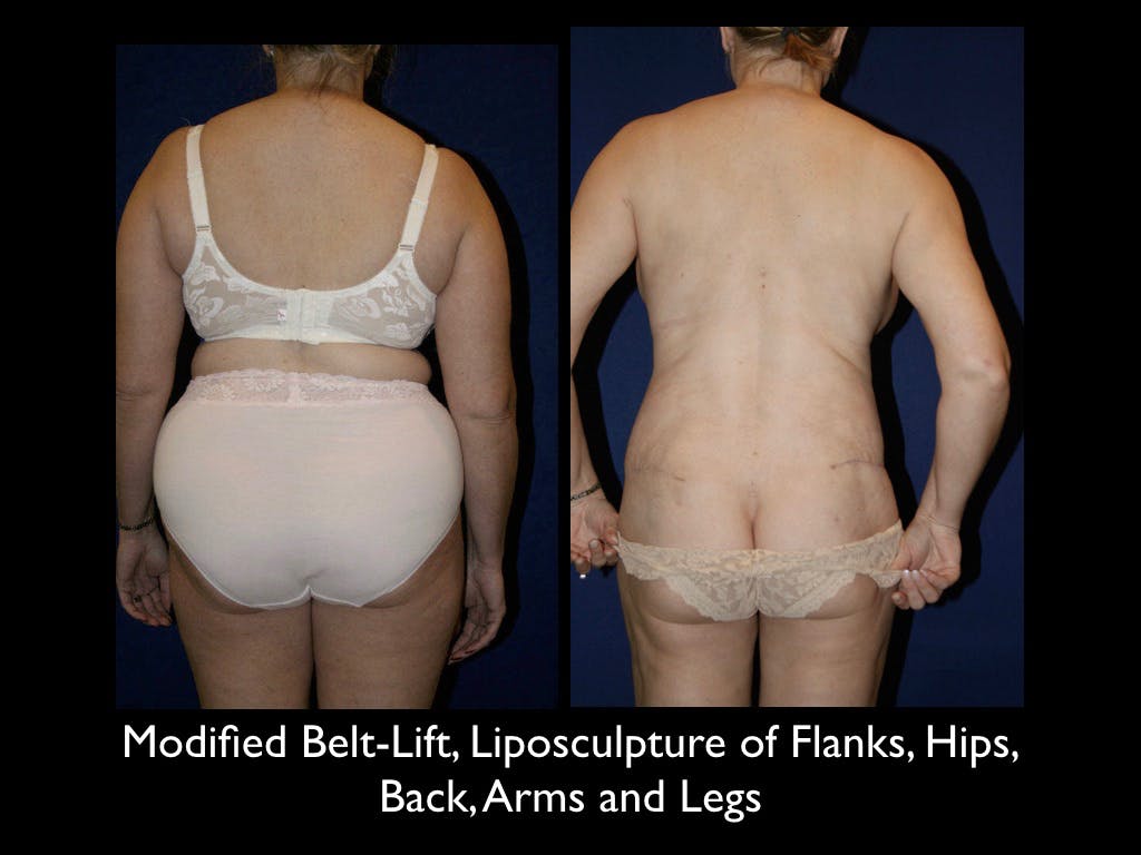 Liposculpsure Before & After Gallery - Patient 79204912 - Image 1