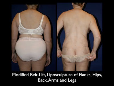 Liposuction Before & After Gallery - Patient 79204912 - Image 1