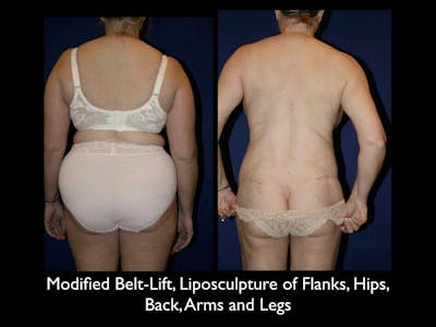 Liposculpsure Before & After Gallery - Patient 79204912 - Image 1