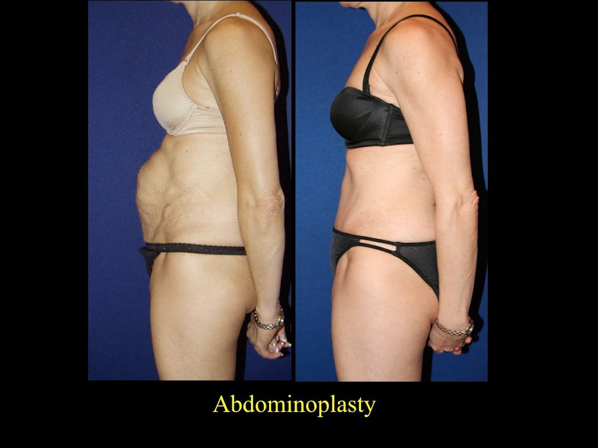 Tummy Tuck Before & After Gallery - Patient 79205151 - Image 1