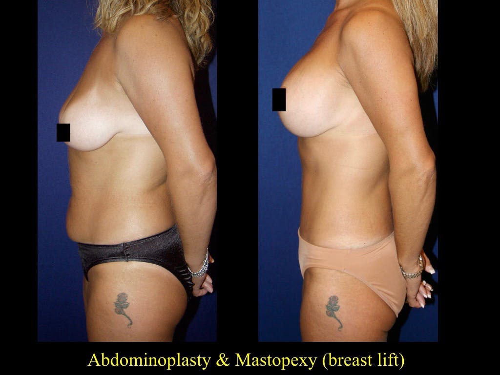 Tummy Tuck Before & After Gallery - Patient 79205152 - Image 1