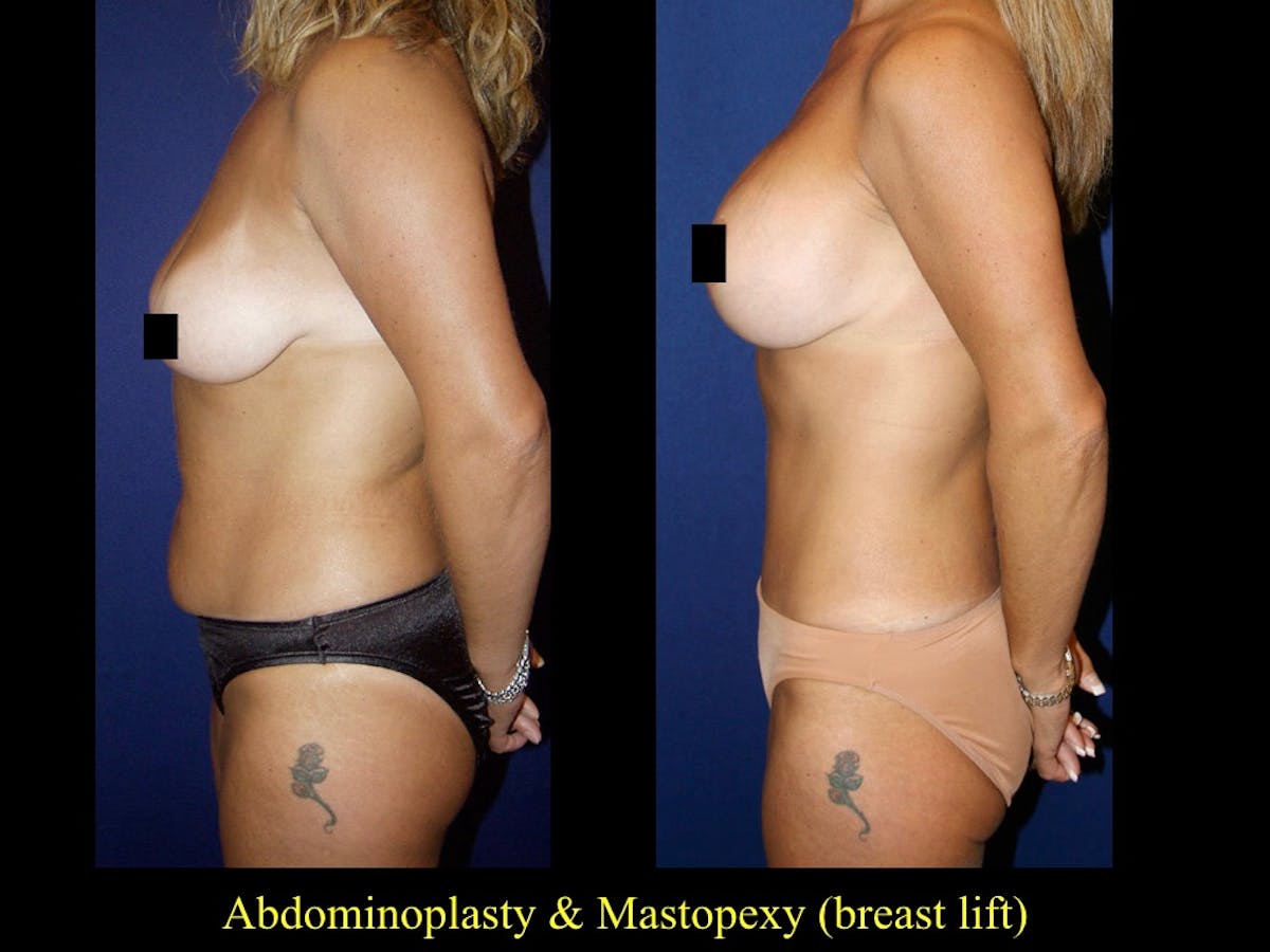 Tummy Tuck Before & After Gallery - Patient 79205152 - Image 1