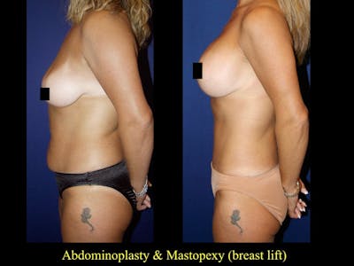 Tummy Tuck Before & After Gallery - Patient 79205152 - Image 1
